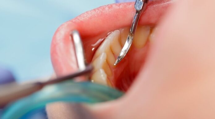 טיפולי שיניים בהרדמה מלאה מחירים